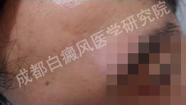 治疗前,患者额头分布块状白斑,有明显的复发的趋势