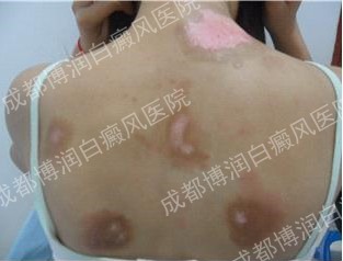 【来院初诊时,患者背部的白斑通过之前的治疗已有黑色素产生,但是停药就复发扩散】