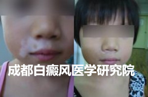 成都白癜风医学研究院
